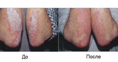 Psorix